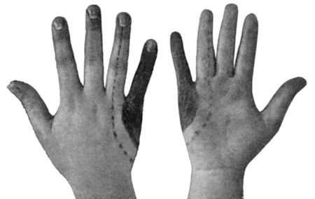 Fig. 92.—To illustrate Loss of Sensation produced by complete Division of Ulnar Nerve. Loss of all forms of cutaneous sensibility is represented by the shaded area. The parts insensitive to light touch and to intermediate degrees of heat and cold are enclosed within the dotted line. (Head and Sherren.)