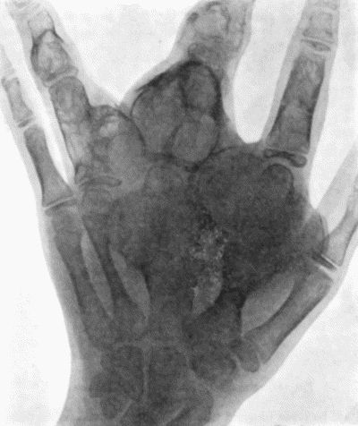 Fig. 143.—Skiagram of Multiple Chondromas shown in Fig. 142.