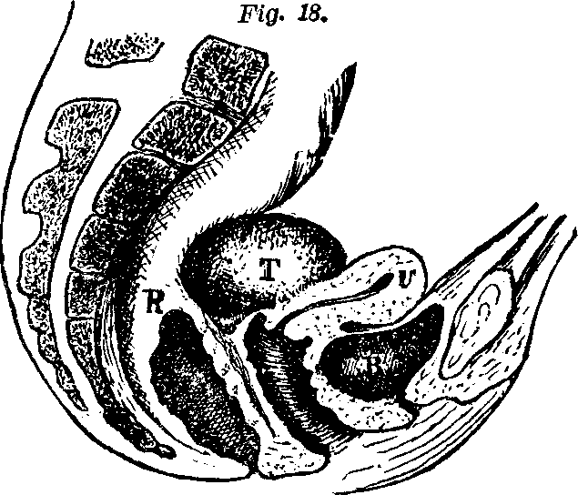 Illustration: Fig. 18. U, Uterus. B, Bladder. R, Rectum. T, Tumor.