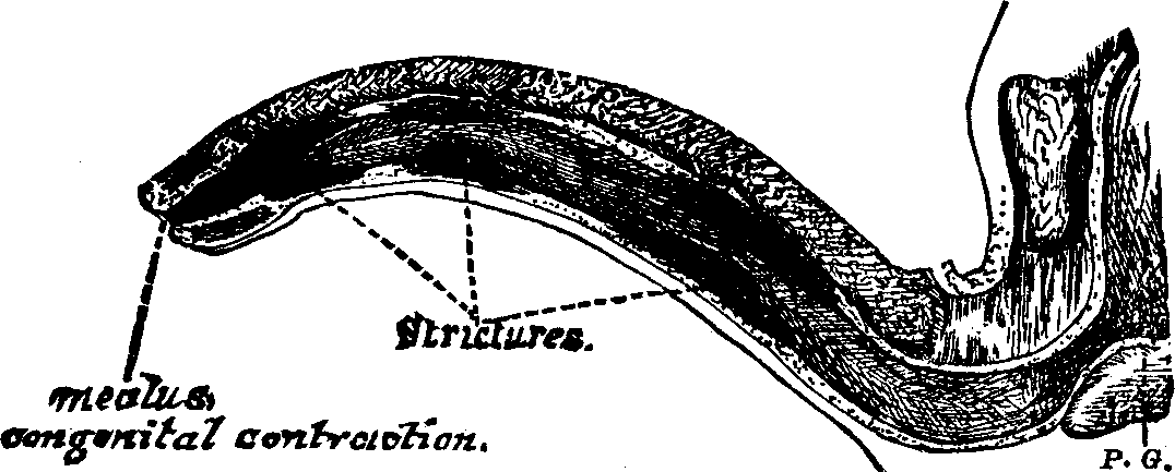 Illustration: Fig. 3. Condition of the Urethra with three Strictures and a congenital contraction at the meatus or outlet.