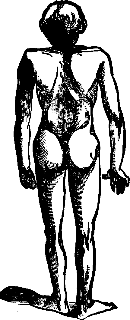 Illustration: Fig. 4. Appearance of a child suffering from Pott's disease of the spine.