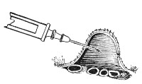 Fig. 183.—Section of abdominal wall, etc., showing point of needle lying free in the peritoneal cavity above the coils of intestine.