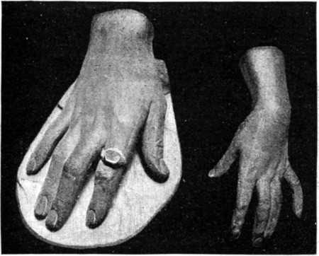 HAND OF ANAK, THE GIANT. HAND OF CAROLINE, SISTER OF NAPOLEON.