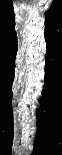 Fig. 3.—Arteriosclerosis of the thoracic and abdominal aorta, showing irregular nodules, atheromatous plaques, denudation of the intima, thin plates of bone scattered throughout with spicules extending into the lumen of the vessel. Note the contraction of the openings of the large branches, the rough appearance of the aorta and the greater degree of sclerosis of the upper two-thirds, i. e., of the aorta above the diaphragm. This aorta in the recent state was much thickened and almost inelastic.