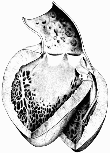 Fig. 4.—Arteriosclerosis of the arch of the aorta. Numerous calcified plaques, thickening and curling of the aortic valves, giving rise to insufficiency of the aortic valves. The aortic ring is rigid and not much dilated. (Milwaukee County Hospital.)