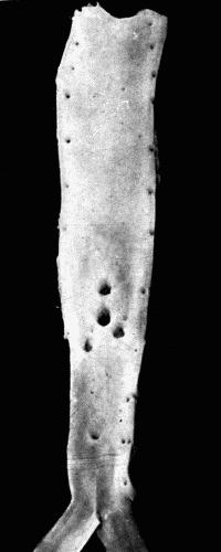 Fig. 5.—Normal aorta. Compare with Fig. 3. Note the perfectly smooth, glossy appearance of the intima. The openings of all the intercostal arteries are distinctly seen. In the recent state this artery was highly elastic, capable of much stretching both transversely and longitudinally.