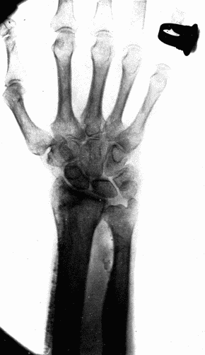 Fig. 6.—Radiogram of a man aged seventy-five, showing calcification of both radial and ulnar arteries.