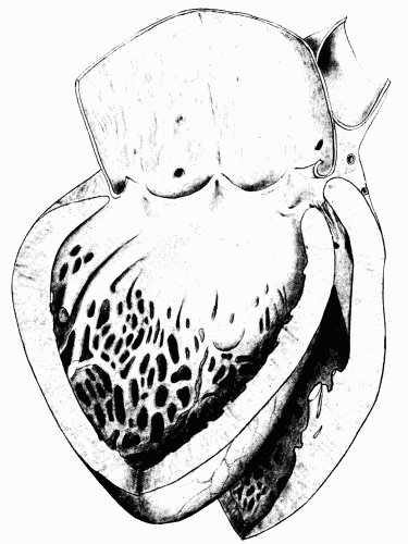 Fig. 7.—Syphilitic aortitis of long standing. The aortic valves are curled and thickened, the heart is enlarged and the cavity of the left ventricle is dilated. (Milwaukee County Hospital.)