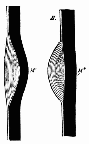 Fig. 8.—I, media weakened at M' with overgrowth of intima filling in the depression. II, with postmortem rigor and contraction of the muscles of the media and removal of the blood pressure from within, the stretched media at M'' contracts; the intimal thickening thus projects into the arterial lumen. (After Adami.)