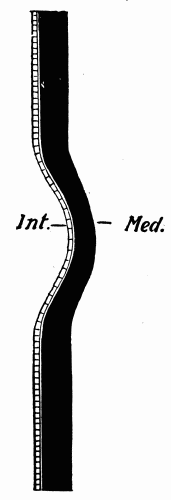 Fig. 9.—Schematic representation of the increased strain brought to bear upon the cells of the intima, Int., when the media, Med., undergoes a localized expansion through relative weakness. (After Adami.)