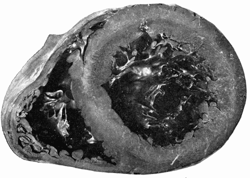 Fig. 11.—Enormous hypertrophy of left ventricle probably due to prolonged increased peripheral resistance. Note that the whole anterior surface of the heart is occupied by the left ventricle. The right ventricle does not appear to be much affected. × ⅔.