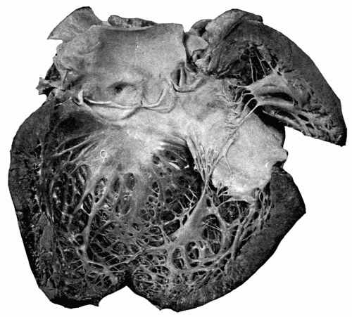 Fig. 12.—Aortic incompetence with hypertrophy and dilatation of left ventricle, the result of arteriosclerosis affecting the aortic valves. Note how the valves have been curled, thickened, and shortened, the edges of valves being a half inch below the upper points of attachment. The anterior coronary artery is shown, the lumen narrowed. (Reduced one-half.)