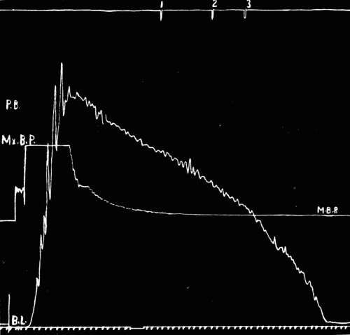 Fig. 29.—Tracing of auscultatory phenomena. (See explanation in legend of Fig. 30.)