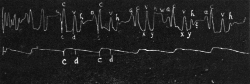 Fig. 37.—Jugular and carotid tracing from a normal individual with a well-marked third heart sound showing a large "h" and a smaller pre-auricular wave "w." ? indicates a small wave in mid-diastole following the "h" wave, occasionally found though perhaps an artefact. (After Hirschfelder.)