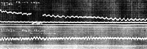 Fig. 44.—Upper curve. Record obtained during period of cardiac syncopy at 2:48 p.m., Lead II. Lower curve from dog. Ventricular fibrillation observed in the exposed heart. Lead from right foreleg and left hind leg. (Courtesy of Dr. G. C. Robinson.)