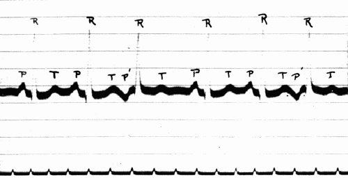 Fig. 45.—Electrocardiogram showing auricular extrasystoles (P). (Courtesy of Dr. G. C. Robinson.)