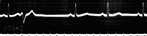 Fig. 46.—Electrocardiogram showing ventricular extrasystole. Heart rate 56-60 beats per minute. Note that diastolic pause in which extrasystole occurs is practically equal to two normal diastolic pauses. (Courtesy of Dr. G. C. Robinson.)