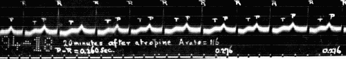 Fig. 47.—Electrocardiogram showing delayed conduction (lengthening of P-R interval). These P-R intervals are quite regular. When irregular there is apt to be extrasystole of ventricle or occasional blocking of impulse going to ventricle. (Courtesy of Dr. G. C. Robinson.)