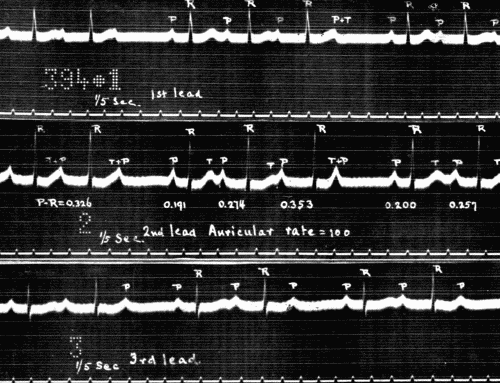 Fig. 48.—Electrocardiogram showing partial heart-block in the three leads. Note the variability of P-R interval calculated in seconds in Lead II. (Courtesy of Dr. G. C. Robinson.)