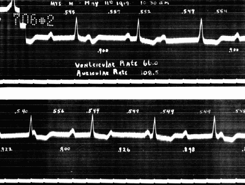 Fig. 49.—Complete heart block. (Courtesy of Dr. G. C. Robinson.)