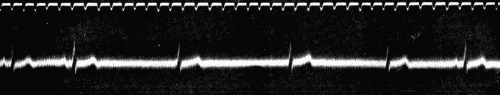 Fig. 50.—Showing alternating periods of sinus rhythm and auriculoventricular rhythm. (After Eyster and Evans.)