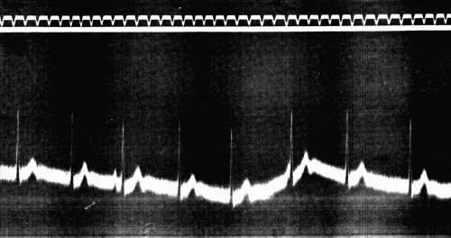 Fig. 51.—Period of auriculoventricular or "nodal" rhythm following exercise in sitting posture. (After Eyster and Evans.)