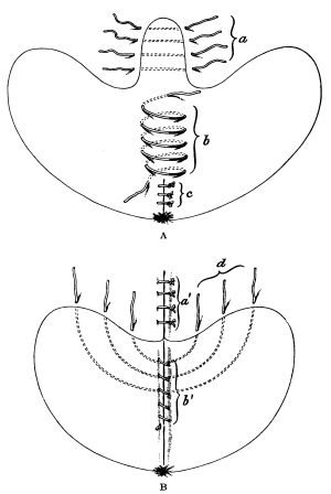 Complete Laceration of the Perineum