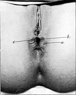 Repair of a Lacerated Perineum