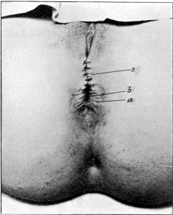 Repair of a Laceration of the Perineum after a Plastic Operation