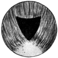 Iridotomy by Ziegler’s Method