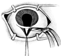 Iridectomy for Glaucoma