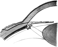 Lagrange Operation For Chronic Glaucoma