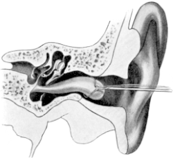 Wilde’s Snare being passed round an Aural Polypus