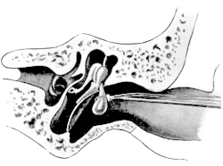 Polypus arising from the Attic Region