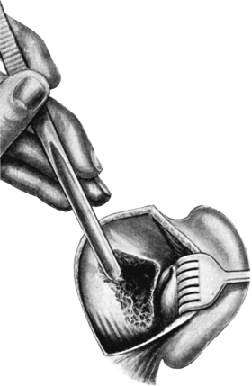 Schwartze’s Operation