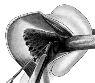 The ‘Radical’ Mastoid Operation