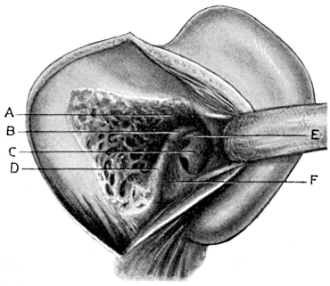 The ‘Radical’ Mastoid Operation completed