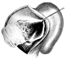 Skin-grafting of Mastoid Wound Cavity after Operation