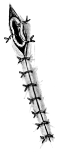 Method of suturing the Open End of the Internal Jugular Vein in the Neck