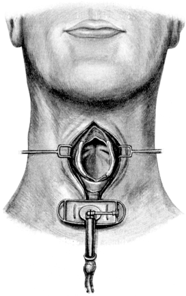 Thyrotomy