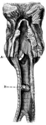 Trachea showing Ulceration caused by a Badly Fitting Tube