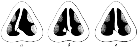 The Gleason-Watson Operation for Deformity of the Septum