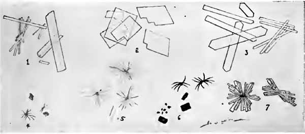 Unusual urinary crystals