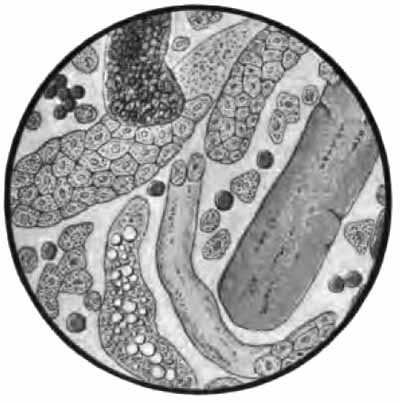 Sediment from chronic parenchymatous nephritis