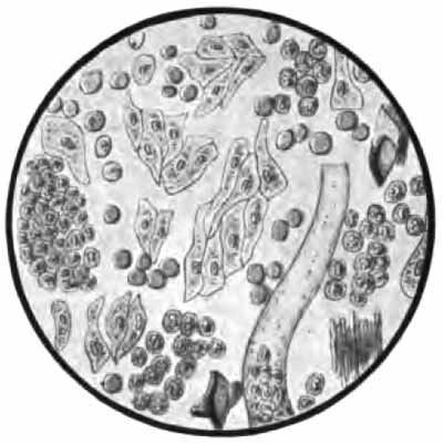 Sediment from calculous pyelitis