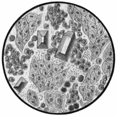 Sediment from cystitis