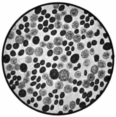 Splenomedullary leukemia