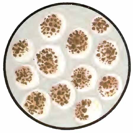 Heart-failure cells in sputum