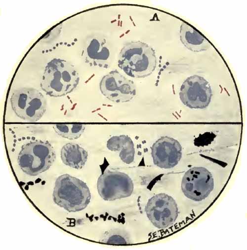 Sputum showing tubercle bacilli