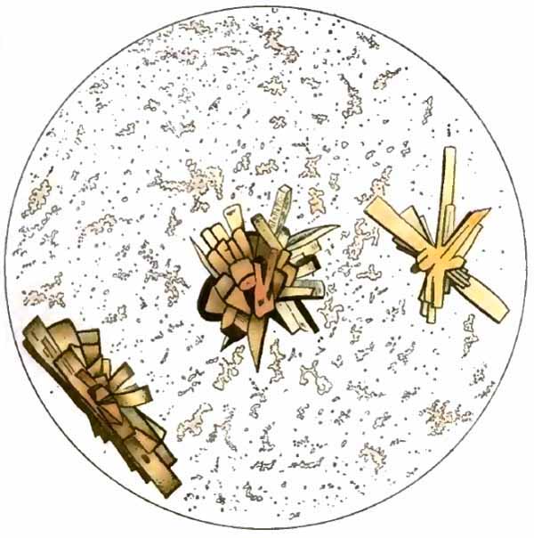 Uric-acid crystals with amorphous urates